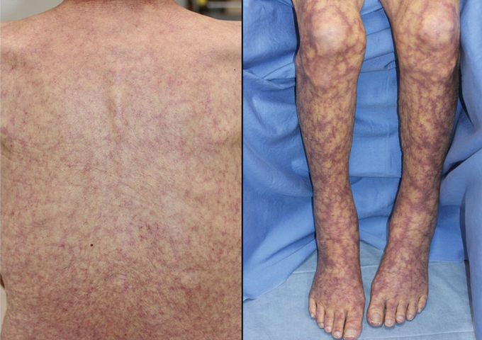 CAD “cold agglutination disease”or “cold antibody hemolytic anemia”
