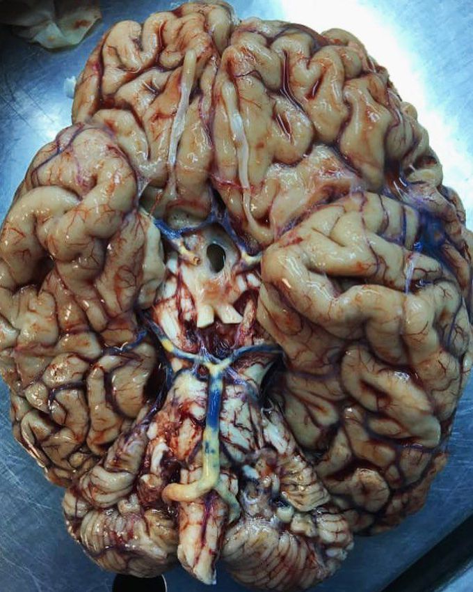 The brain is a 87-year-old having a cerebral atherosclerosis!!!