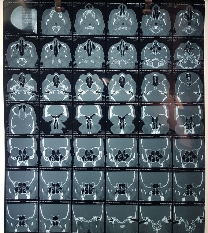 CT paranasal sinuses