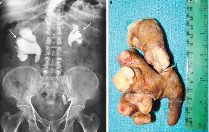 Staghorn stones