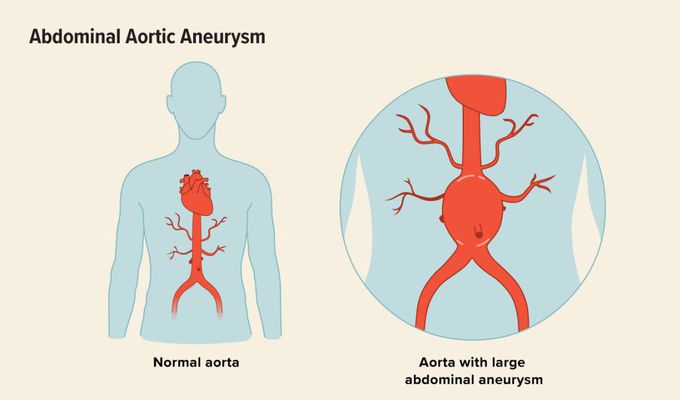 Abdominal Aortic Aneurysm