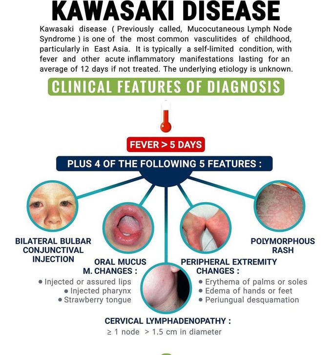 Kawasaki Disease - MEDizzy