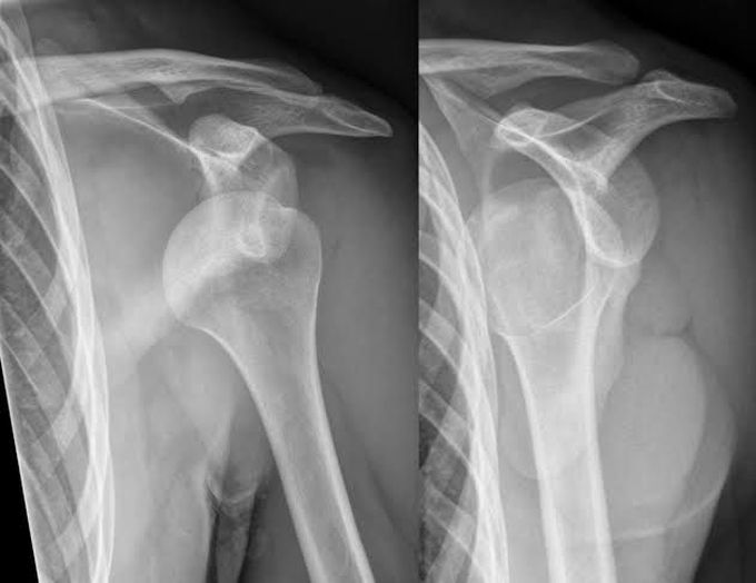 Shoulder Dislocation