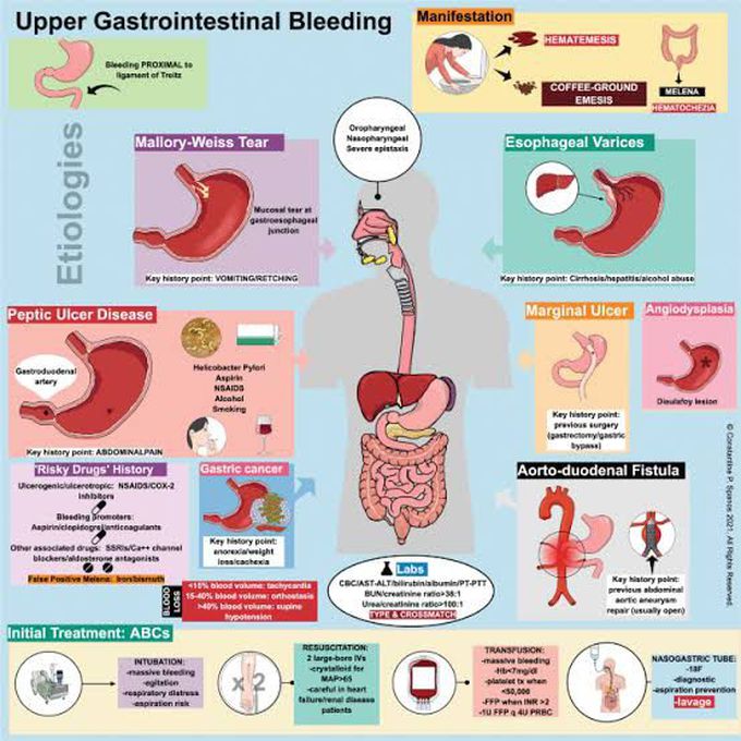 Causes of Upper GI Bleeding