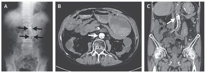 Aortic Calcification and Superior-Mesenteric-Artery Stenosis