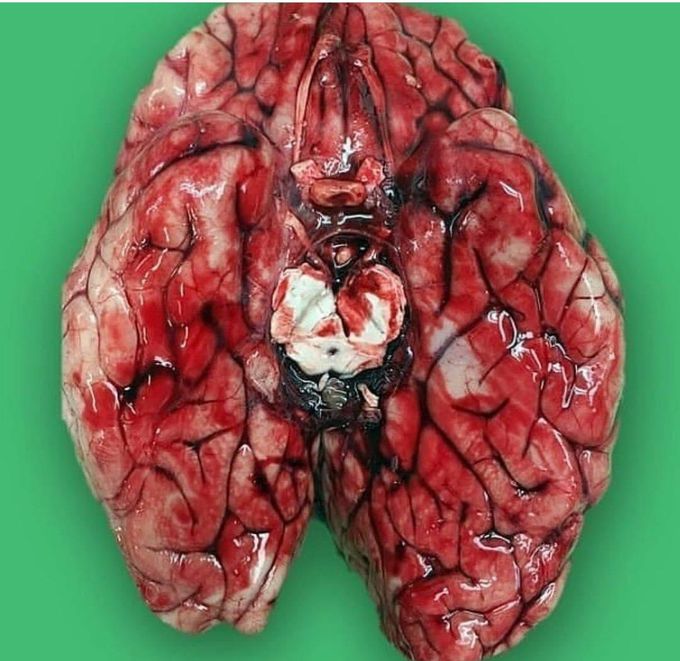 Sub arachnoid hemorrhage