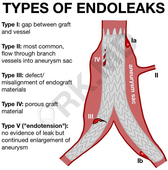 Types of Endo Leaks
