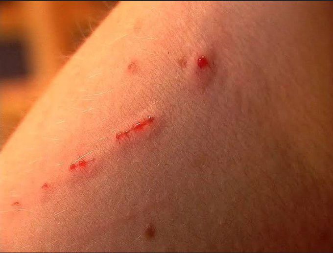 Cat scratch disease