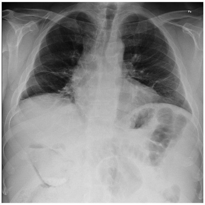 Emphysematous Cholecystitis