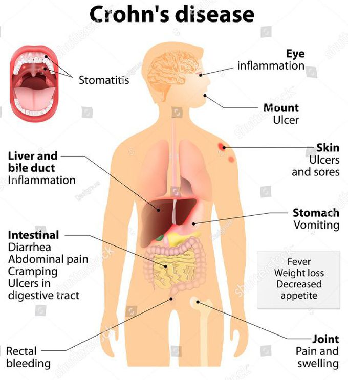 Crohn’s Disease