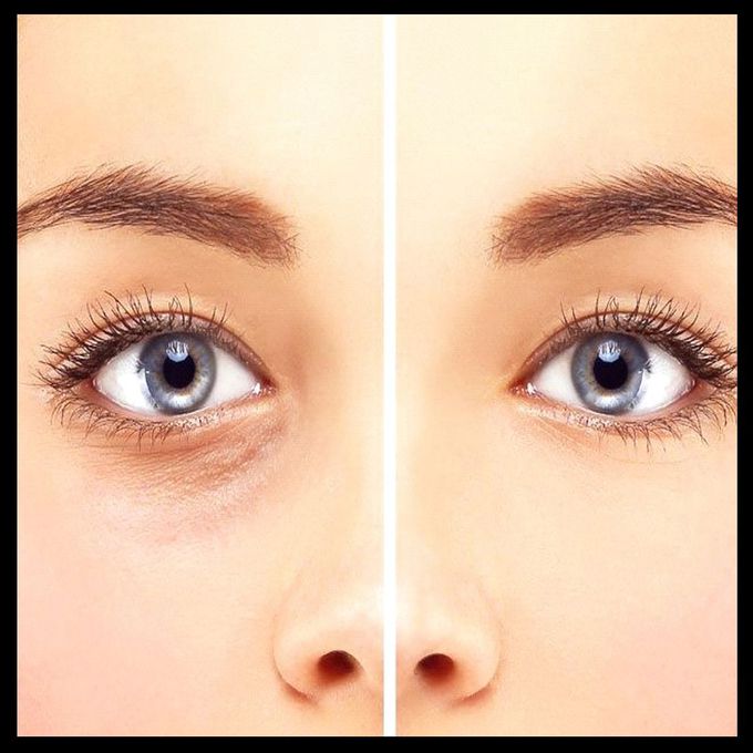 Blepharoplasty Doctor in Delhi