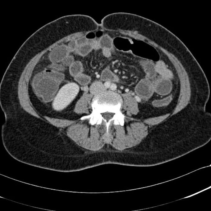 Contraindications of CAT Scan