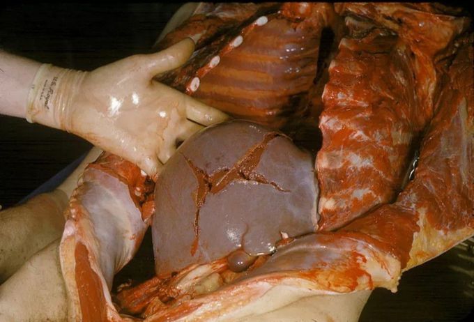Ruptured liver...