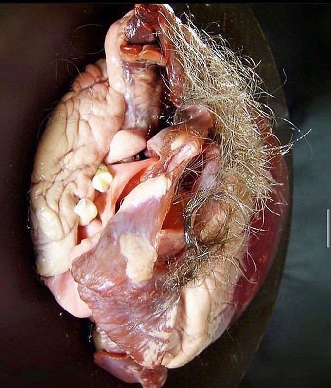 Mature cystic teratoma