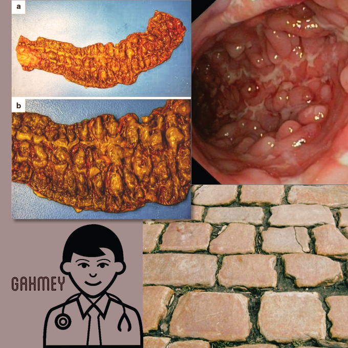 Characteristic Cobblestone appearance of the colon in crohn's disease.