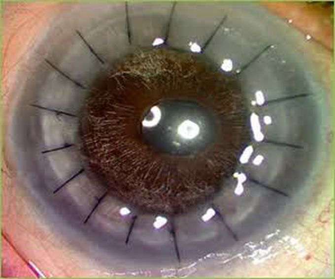 Keratoplasty