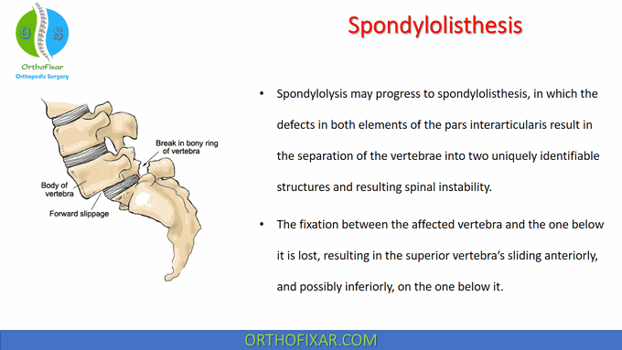 Spondylolisthesis: Causes, Symptoms & Treatment • Easy Explained - 2022