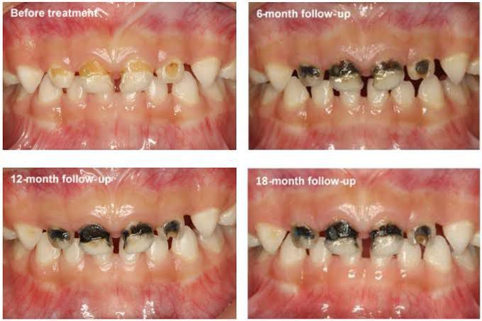 Dental Carries