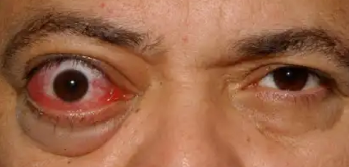 EYE DISEASE