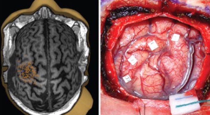 Neurosurgery