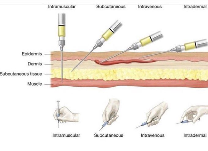 Types of injection - MEDizzy