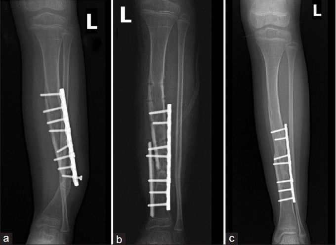 How to treat osteogenesis imoerfecta