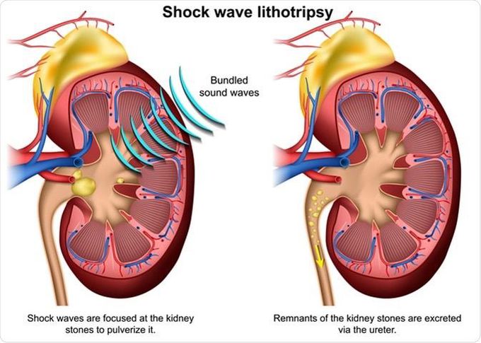 Lithotripsy:
Lithotripsy is a procedure that uses shock waves to break up stones in the kidney and parts of the ureter (tube that carries urine from your kidneys to your bladder). After the procedure, the tiny pieces of stones pass out of your body in your urine.