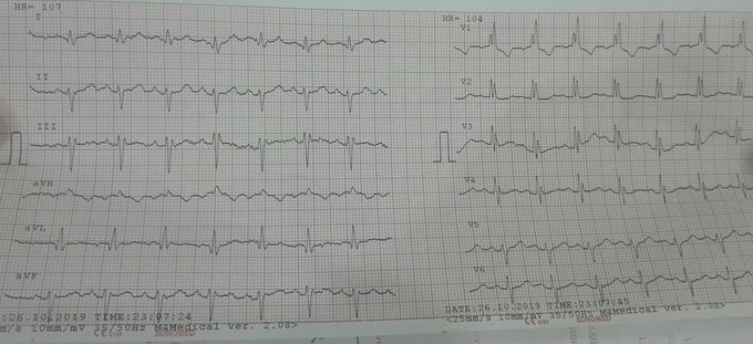 ECG_blocks