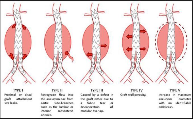 Classification of endoleaks