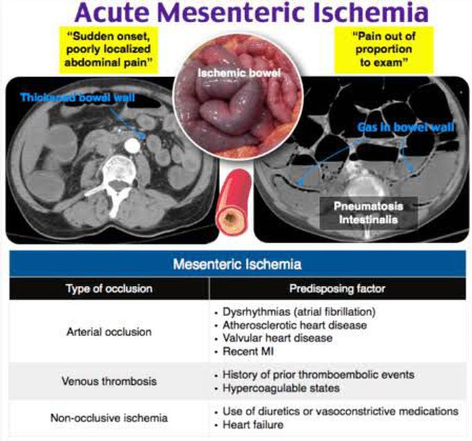 Acute mesenteric Ischemia