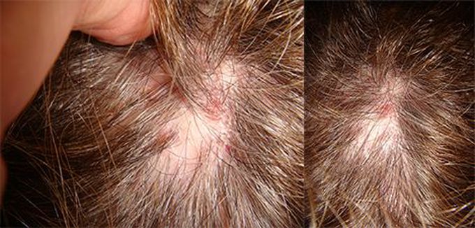 Cicatricial Alopecia