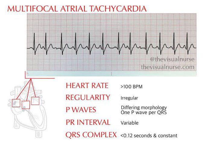 MultiFocal Atrial Tachycardia