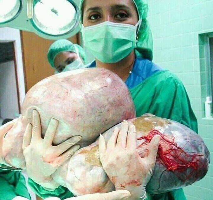 Cystic ovarian tumor