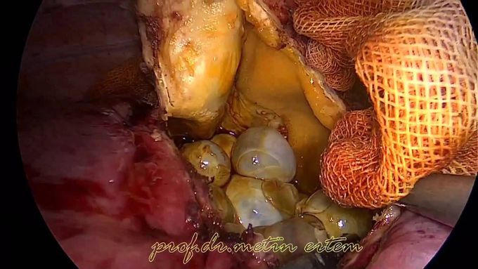 Hydatid cysts of the liver. Metin Ertem MD,FACS