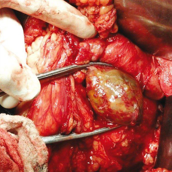 Pheochromocytoma of the adrenal gland