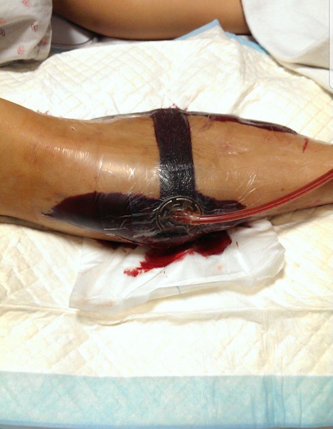 Popliteal aneurysm