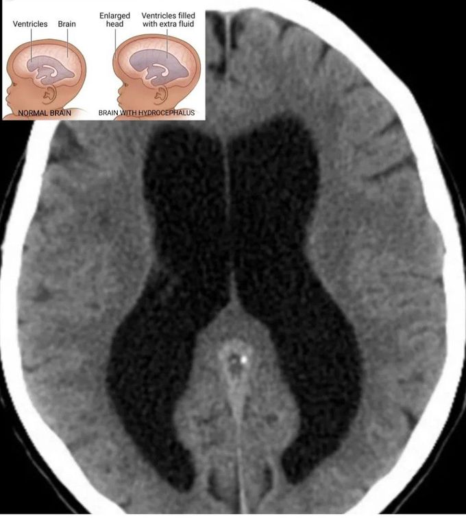 Hydrocephalus