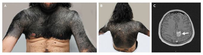 Congenital Melanocytic Nevus