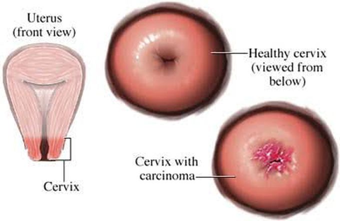 Causes of vaginal cancer