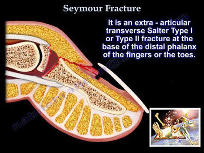 Complex Pediatric Fracture, Seymour Fracture - Everything You Need To Know - Dr. Nabil Ebraheim