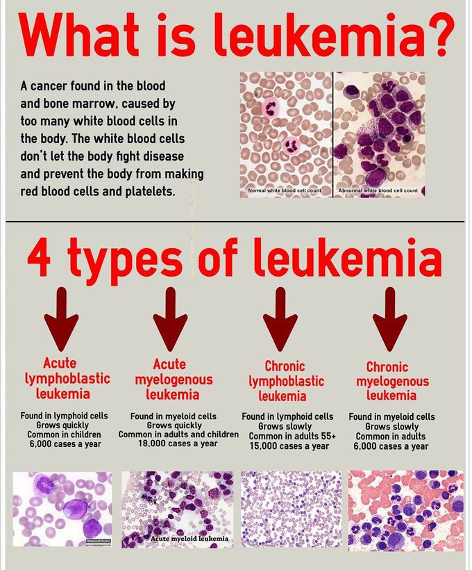 Classification of Leukemia