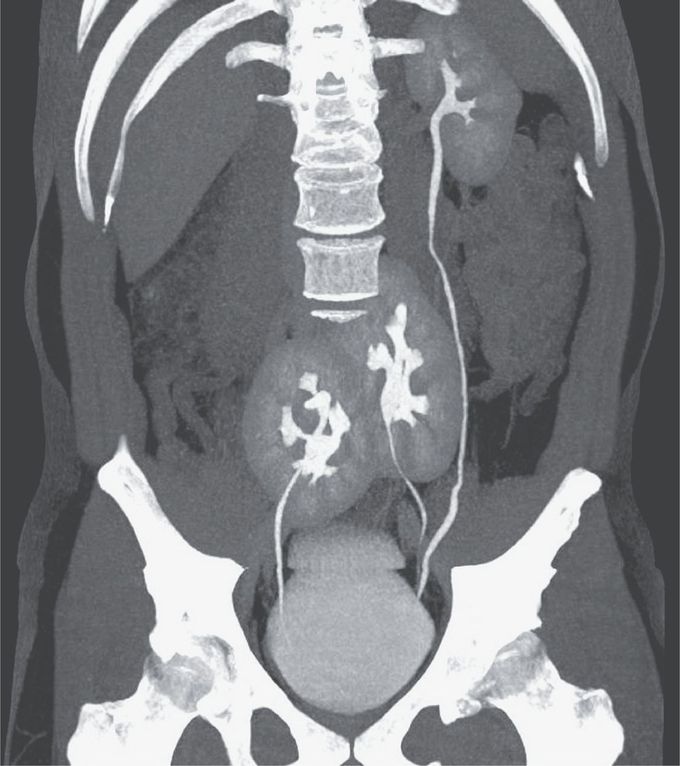 Three Kidneys