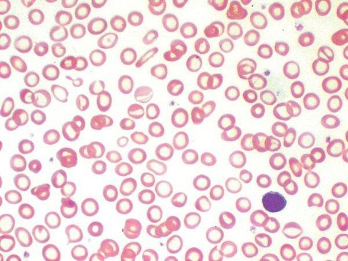 Iron deficiency anemia