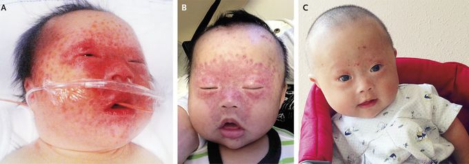Neonatal Lupus