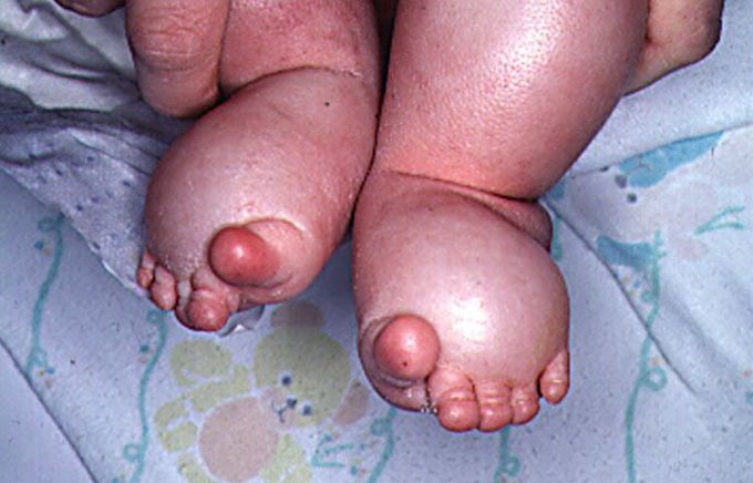 Turner Syndrome