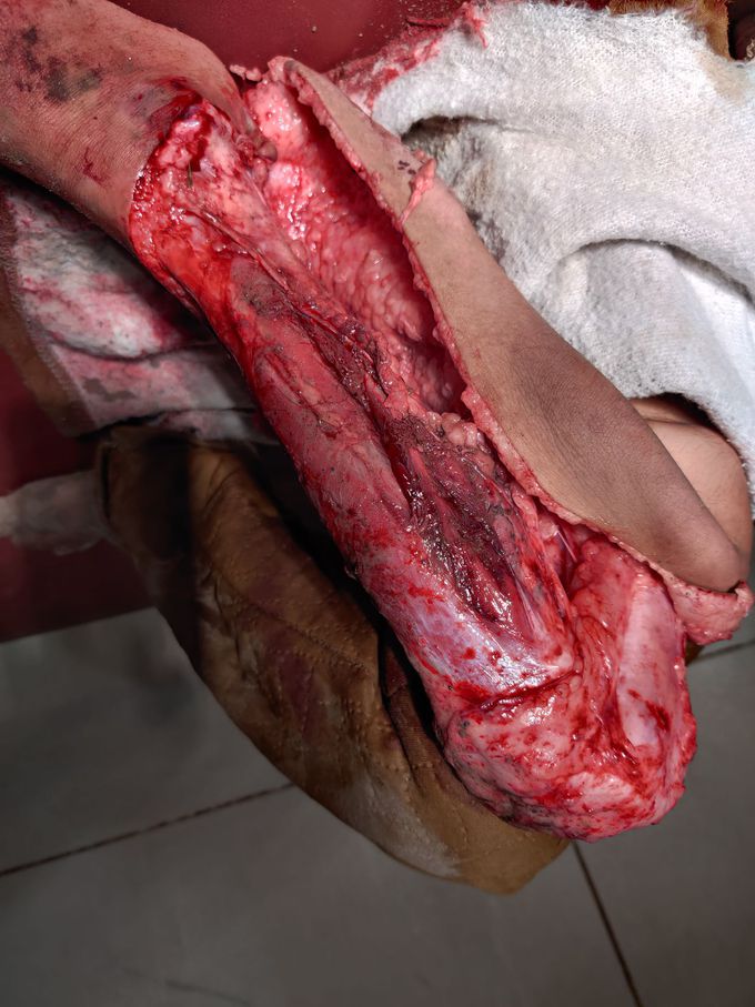 Traumatic Laceration R leg