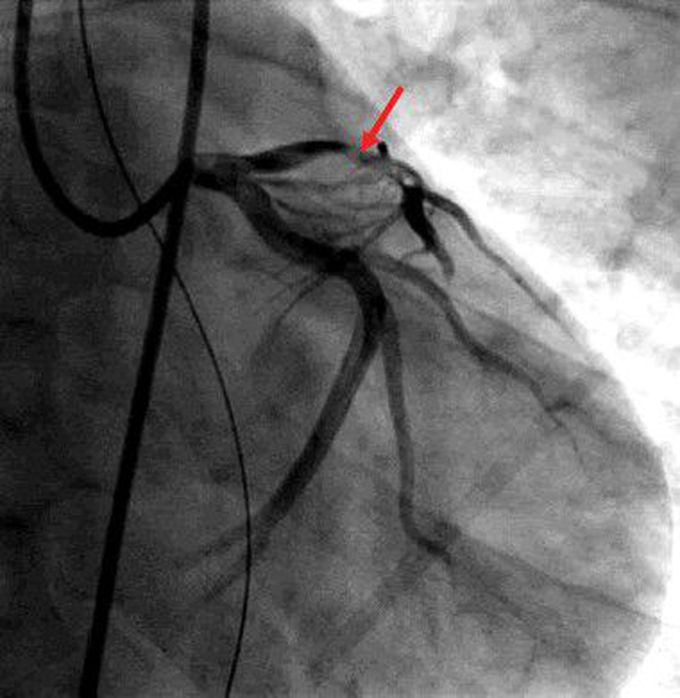 Unusual Acute Myocardial Infarction in Young Male with Hereditary Protein C and S Deficiency