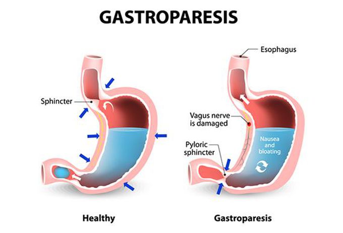 Gastroparesis.