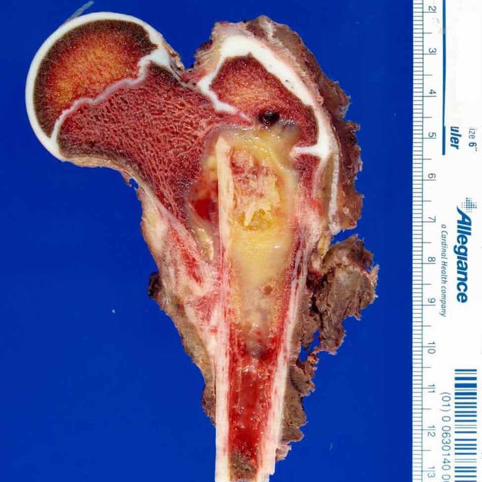 PROXIMAL FEMUR RESECTION