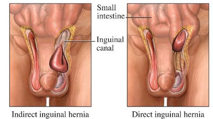 Indirect inguinal hernia and direct inguinal hernia